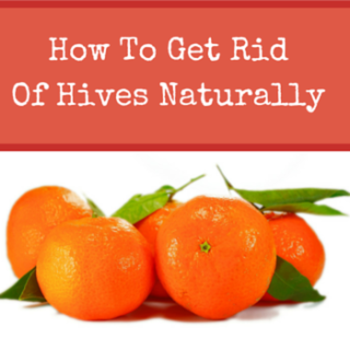 how-to-get-rid-of-hives-naturally-a-listly-list