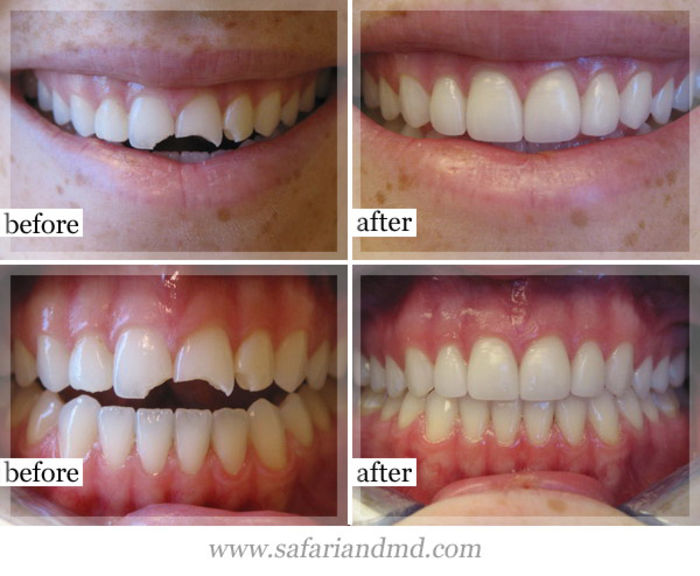 List of 10 Most Common Dental Treatments A Listly List