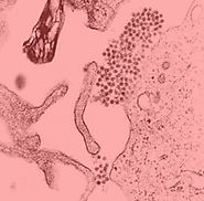 Dengue