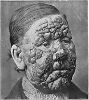Leprosy