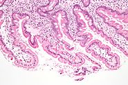 Giardiasis
