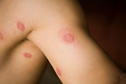Ringworm