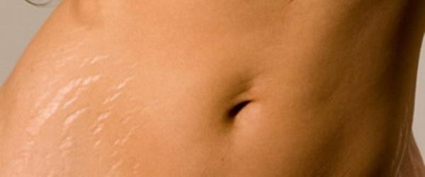 Pictures Of Stretch Marks After Weight Loss